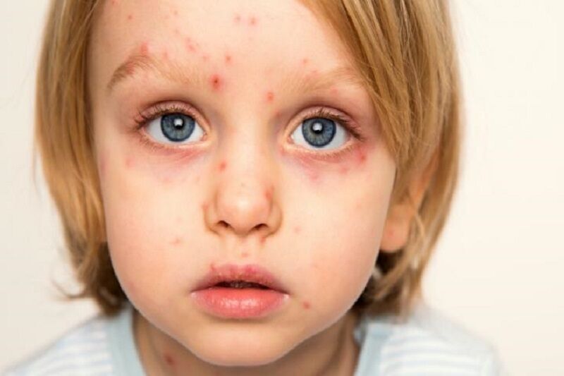 سرخک در کودکان چه علائمی دارد/ زمان مناسب برای زدن واکسن سرخک