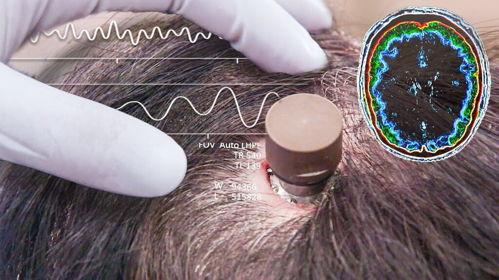 وضعیت اولین بیمار فلج دریافت‌کننده تراشه مغزی  + تصاویر  | رویای ایلان ماسک به واقعیت تبدیل شد؟