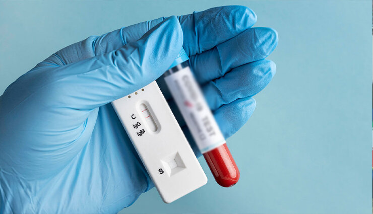 کیت تشخیص سریع HIV بومیسازی میشود