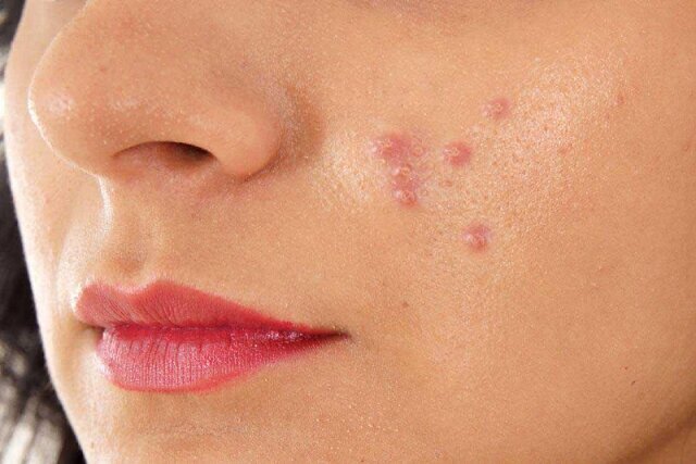 این مواد غذایی باعث بروز آکنه و جوش میشوند