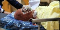 لزوم تشکیل صندوق ویژه حوادث سوختگی در کشور/ کمبود ۱۲۰۰ تخت سوختگی در کشور