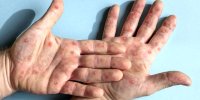 آبله میمونی واکسن دارد؟