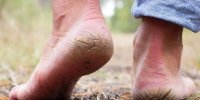 کمبود کدام ویتامین‌ها باعث پوسته شدن کف پا می‌شود؟