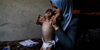 تصاویری رقت‌انگیز از شرایط بحرانی کودک سه ساله در جبالیا