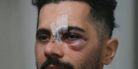 جدیدترین تصاویر از صورت ورم کرده و دندان شکسته کاپیتان پرسپولیس | پیام احساسی امید عالیشاه بعد از مصدومیت دردناک