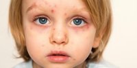 همه‌چیز در مورد یک ویروس بهاری؛ بیشتر مراقب کودکان خود باشید