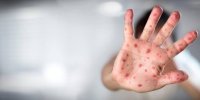 ببینید| هر آنچه که باید درباره ویروس آبله میمون بدانید در دو دقیقه