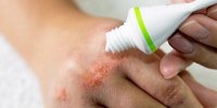 آلرژی‌های ناشی از محصولات آرایشی، چالشی جدی اما قابل پیشگیری