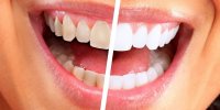 افشای رازهای مهم سلامتی شما با رنگ دندان هایتان/ خطرناک ترین لکه چه رنگی است؟