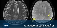 ویدیو/ چرا آمیلوئید عروقی مغز خطرناک است؟