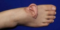 نجات لاله گوش زن چینی با پیوند موقت روی پا
