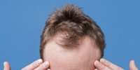 کدام ریزش مو در مردان شایع‌تر است؟