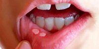 زخم‌های دردناک دهان چگونه ایجاد می شوند؟