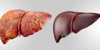 لاغرها هم کبد چرب می‌گیرند؟