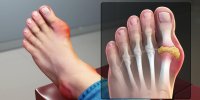 مهم‌ترین نشانه نقرس؛ چرا بعضی‌ها به نقرس مبتلا می‌شوند؟/ حمله‌های نقرسی خودبه‌خود خوب می‌شود اما...