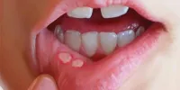 زخم‌های دردناک دهان از کجا می‌آیند؟/ دلایل شایع و راه‌های کاهش درد و پیشگیری