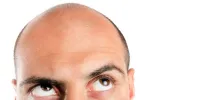 راه های ساده برای پیشگیری از طاسی سر