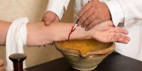 فواید و عوارض فصد خون در طب سنتی
