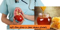 راهنمای مصرف عسل در درمان سنگ کلیه