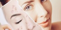 چگونه لکه های تیره پوست را از بین ببریم؟