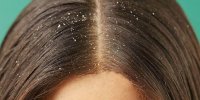 سیر برای شوره سر - نحوه استفاده، فواید، خطرات