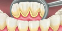 علت اصلی تورم لثه