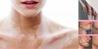 چه چیزی باعث نقاط سفید بر روی پوست شما می شود؟