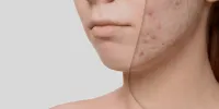 چگونه به طور موثر از شر جای جوش خلاص شویم