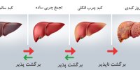 راه های پاکسازی کبد چرب!