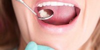 علت زخم و عفونت روی زبان چیست؟