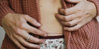 همه آنچه باید در مورد جای زخم سزارین بدانید