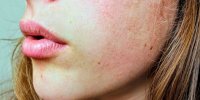 چگونه با پوست خشک زمستانی مبارزه کنیم؟