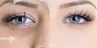 صفر تا صد تزریق فیلر زیر چشم