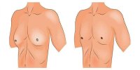 تشخیص و مقابله با ژنیکوماستی