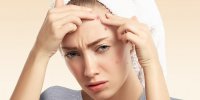 آکنه کیستیک: شناسایی، علل، علائم، و درمان