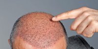 برای جراحی کاشت مو چه اقداماتی را باید انجام دهیم؟