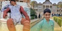 آخرین وضعیت سلامتی علی لندی نوجوان 15 ساله ایذه ای پس از سوختگی