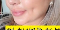 عمل زیبایی چال گونه بر زیبایی لبخند
