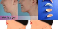 هزینه جراحی پروتز چانه چقدر است/ مزایا و معایب پروتز چانه