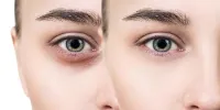 هزینه کربوکسی تراپی چقدر است و چه کاربردی دارد؟