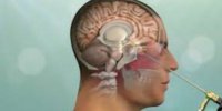 آندوسکوپی مغز، بیرون‌زدگی دیسک گردن و جراحی تومور هیپوفیز