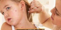 افزایش شیوع سرخک در جهان