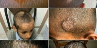 بیماری کچلی دانش آموزان‌ شمس آباد ایرانشهر کنترل شده است