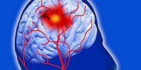 راه های پیشگیری از سکته مغزی را بدانیم