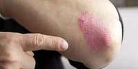 ارتباط بیماری پوستی پسوریازیس و بیماری های روانی