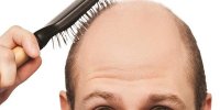 کنترل ریزش ارثی مو باید از نوجوانی آغاز شود