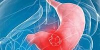 راه‌هایی برای تشخیص زودهنگام سرطان گوارش