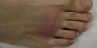 دلایل انحراف انگشت شست پا/۱۵۰ نوع روش جراحی