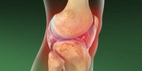 آرتریت سپتیک چیست و چه علائمی دارد؟