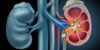 تشخیص ژنتیکی بیماری کلیه پلی کیستیک اتوزومال غالب